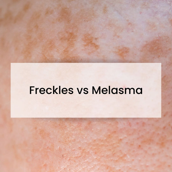 Freckles vs Melasma