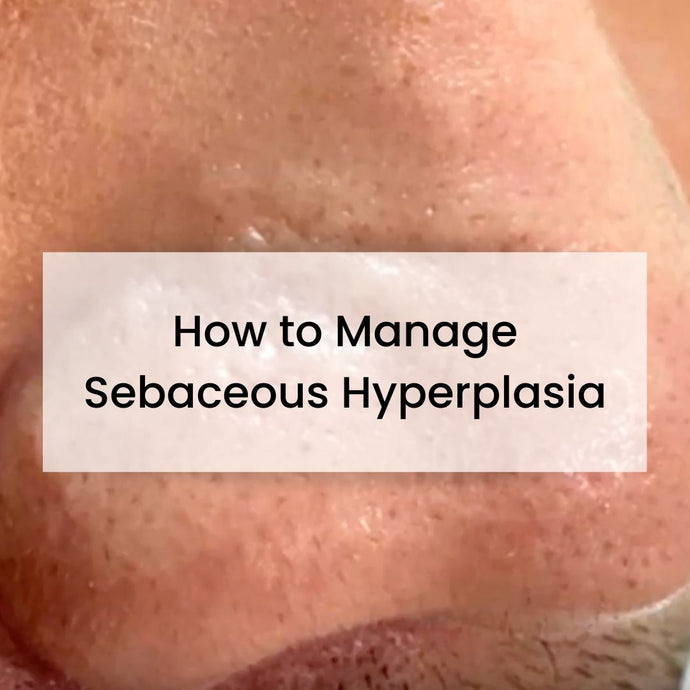 How To Manage Sebaceous Hyperplasia