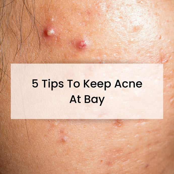 5 Tips On How To Keep Acne At Bay