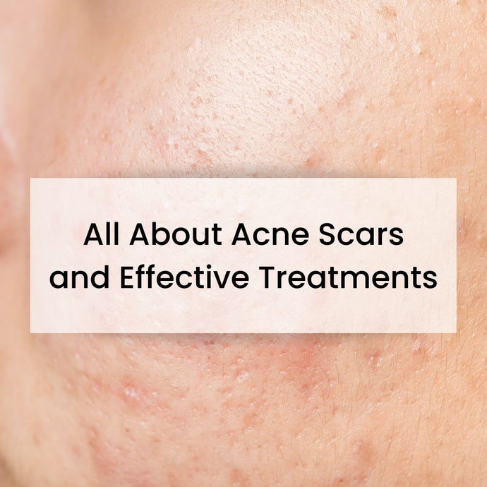All About Acne Scars