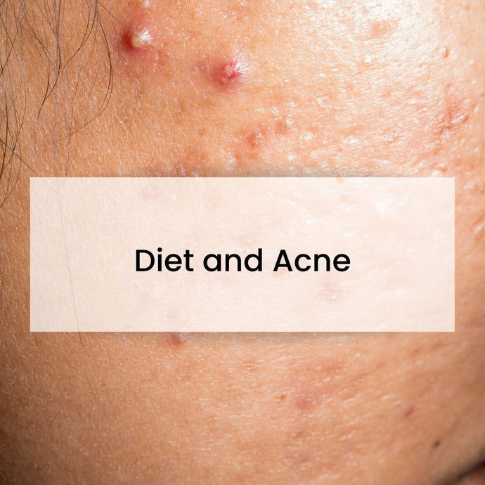 Diet and Acne