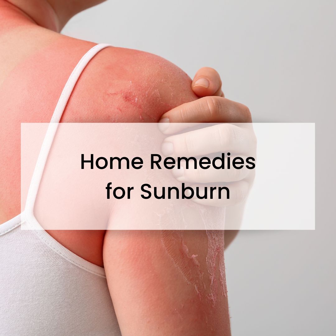 Natural Sunburn Remedies. Lakeshore RV Blog