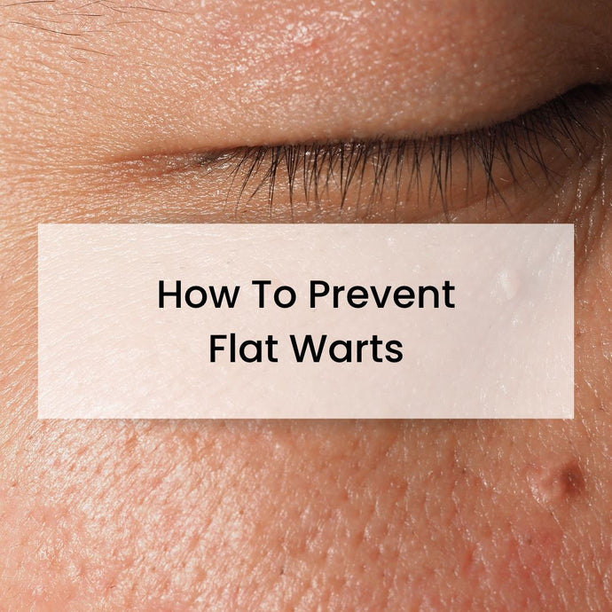 How To Prevent Flat Warts