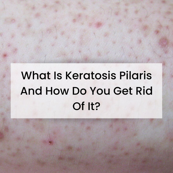 What is Keratosis Pilaris and How Do You Get Rid Of It?