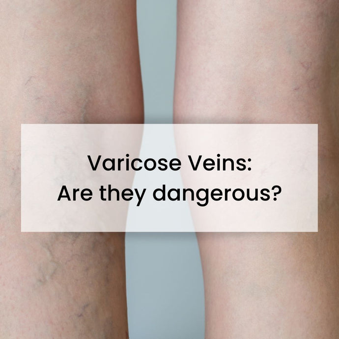 Are Varicose Veins Dangerous?