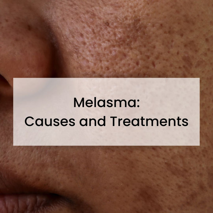 Melasma: Causes and Treatments